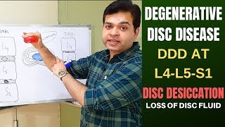 Degenerative Disc Disease DDD L4 L5 L5 S1Disc Desiccation Disc Degeneration Disease Treatment [upl. by Nosraep68]