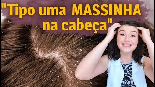 Dermatite Seborreica O que é e como cuidar em casa  Dica de Esteticista [upl. by Vas]