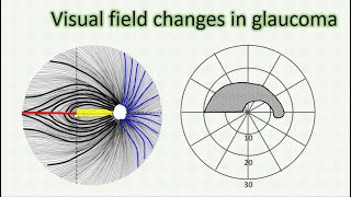 Visual field changes in glaucoma [upl. by Atterys]