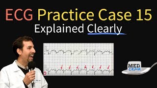 ECG  EKG Practice Case 15  Step by Step Interpretation [upl. by Rebmeced30]