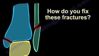 Ankle Fractures Surgical Treatment tactics  Everything You Need To Know  Dr Nabil Ebraheim [upl. by Allerim]