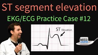 ST Elevation  EKG  ECG Interpretation Case 12 STEMI MI ACS [upl. by Zalucki]