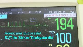 SVT or Supraventricular Tachycardia [upl. by Hirza]