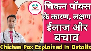 Chicken Pox in hindi Chicken pox Symptoms  DrKSChougule [upl. by Blaine]