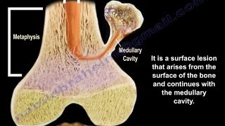 Osteochondroma  solitary and multiple  Everything You Need To Know  Dr Nabil Ebraheim [upl. by Nnylirret]