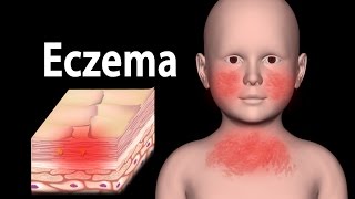 Eczema Animation [upl. by Danelle954]