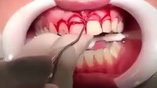 Gingivectomy amp Crown lengthening [upl. by Severson]