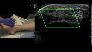 Ultrasound of the Dorsalis Pedis Artery [upl. by Cyna]