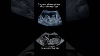 Baby Development on Ultrasound Scan [upl. by Matthus]