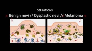 Introduction to Skin Cancer 3 Overview of Nevi and Melanoma [upl. by Spragens]