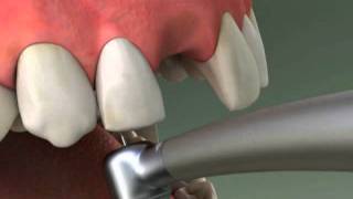 Dentist  Maryland Bridge Procedure [upl. by Arakal]