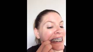 3rd month adult braces [upl. by Merdith]