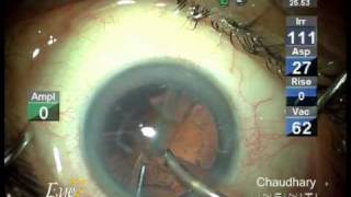 Micro incision cataract surgery MICS by phaco at Eye7 Delhi India [upl. by Ninnahc]