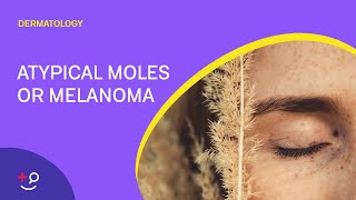 Atypical Moles or Melanoma The ABCDEs Dermatology [upl. by Gorski]