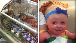 New York Babys Skin Cracked Minutes After Her Birth Due to Rare Condition [upl. by Theurer215]