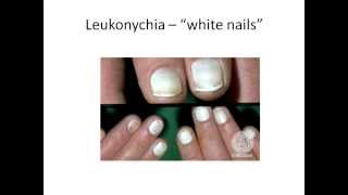 Leukonychia White nails [upl. by Lorrad887]