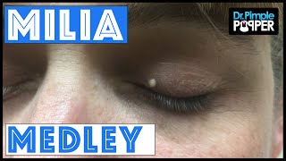 A Dr Pimple Popper Milia Medley [upl. by Roddie]