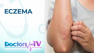 Eczema Symptoms Causes and Treatment  Doctors on TV [upl. by Mignon740]