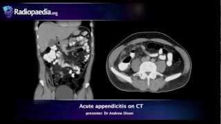 7 Symptoms of Appendicitis  Health [upl. by Eissirc]