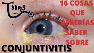 CONJUNTIVITIS16 COSAS QUE DEBERÍAS SABER bacterianadel recien nacidoviralsintomas y tratamiento [upl. by Jun]