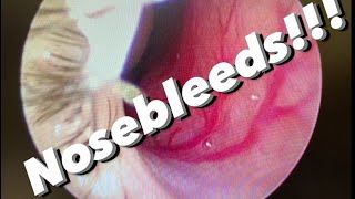 Nosebleeds epistaxis causes prevention treatments and more [upl. by Aittam]