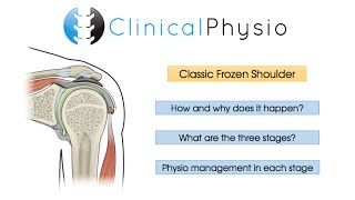 Classic Frozen Shoulder  Clinical Physio [upl. by Anatnahs]