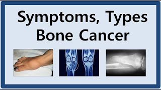 Osteoid Osteoma Bone Pathology Basics [upl. by Roslyn]