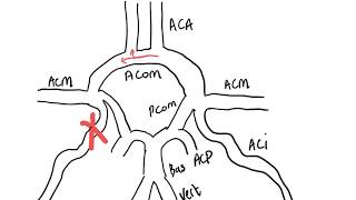 Recovery from an Unruptured Brain Aneurysm [upl. by Tosch]