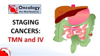 Staging cancers TNM and IIV systems [upl. by Cyprus]