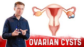 Ovarian Cysts Causes Symptoms amp Natural Treatment – DrBerg [upl. by Theran]