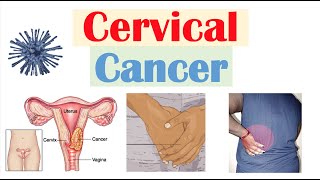 Understanding Cervical Cancer [upl. by Letniuq]