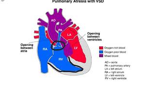 Pulmonary Atresia [upl. by Zorine598]