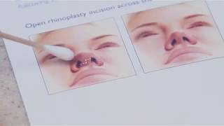 Rhinoplasty  Splint Removal  Dr J J Wendel Plastic Surgery [upl. by Bakemeier97]