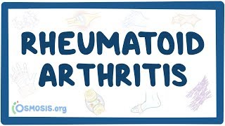 Rheumatoid arthritis  causes symptoms diagnosis treatment pathology [upl. by Alael353]