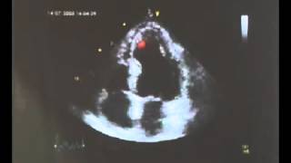 Transthoracic Echocardiogram Showing Akinesis on Apical FourChamber View [upl. by Cormier816]