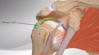 Superior Capsular Reconstruction [upl. by Hemetaf]