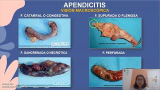 Histología de la Apendicitis aguda [upl. by Carree]