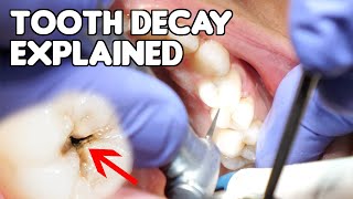 Tooth Decay Cavity Explained  Cavities vs Fillings vs Dental Caries [upl. by Akerley]