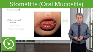 Stomatitis Oral Mucositis – Pediatric Infectious Diseases  Lecturio [upl. by Ahsiener607]