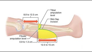 Transtibial Below Knee Amputation for the Ischemic Limbs [upl. by Inot]