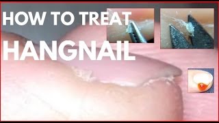 How to treat hangnails Agnail treatment [upl. by Pierson315]