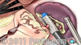 Spleen Removal Surgery Laparoscopic Splenectomy PreOp® Patient Education [upl. by Eymaj]