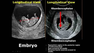 First Trimester amp Ectopic Pregnancy Ultrasound Image Appearances [upl. by Feer]