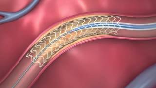 FDAApproved Dissolving Heart Stent  How It Works [upl. by Telrahc]