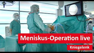 Kniegelenk MeniskusOperation live [upl. by Nivloc632]