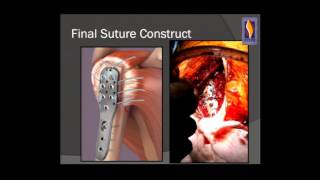 Fracture Healing Part 2  Everything You Need to Know  Dr Nabil Ebraheim [upl. by Goober]