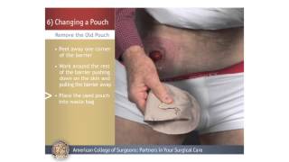 ColostomyIleostomy Changing a Pouch [upl. by Doxia]