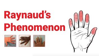 Raynaud’s Phenomenon  What You Should Know  Johns Hopkins Medicine [upl. by Samp]