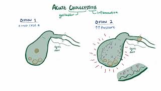 Chronic Cholecystitis with Acute Exacerbation  Histopathology [upl. by Halik775]