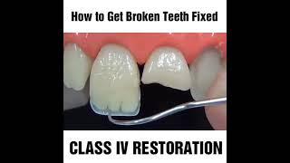 How to fix a chipped cracked or broken tooth MyDentCart  Cracked tooth repair  Broken Tooth [upl. by Converse]